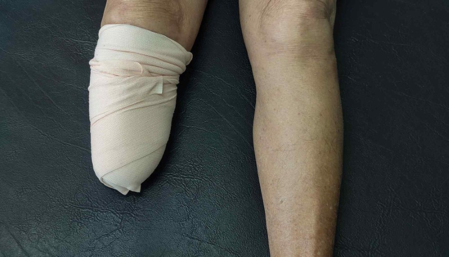 How Amputation Injury Lawyer in Spokane Maximize My Compensation?